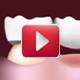   VIDEO |  Soins dentaires Prothèse Bridge  