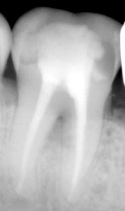 chirurgien dentiste bordeaux endodontie traitant une carie d'une molaire